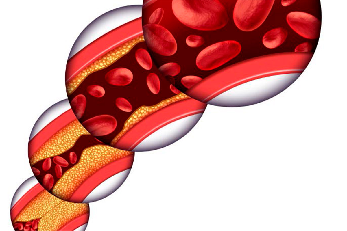 Enfermedad vascular periférica